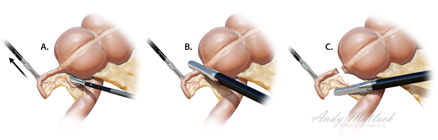 laparoscopic appendectomy