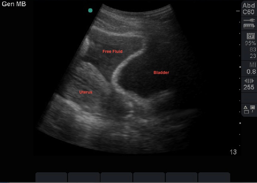 Fluid in Pelvis