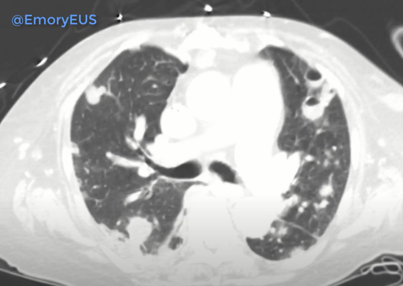 Lung Covid Mimic Still