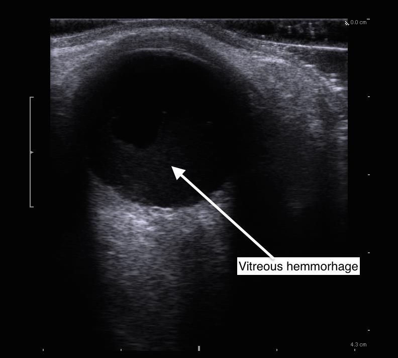 Vitreous Hemorrhage