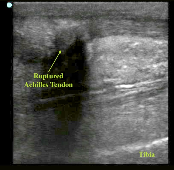 achilles tendon ruptured