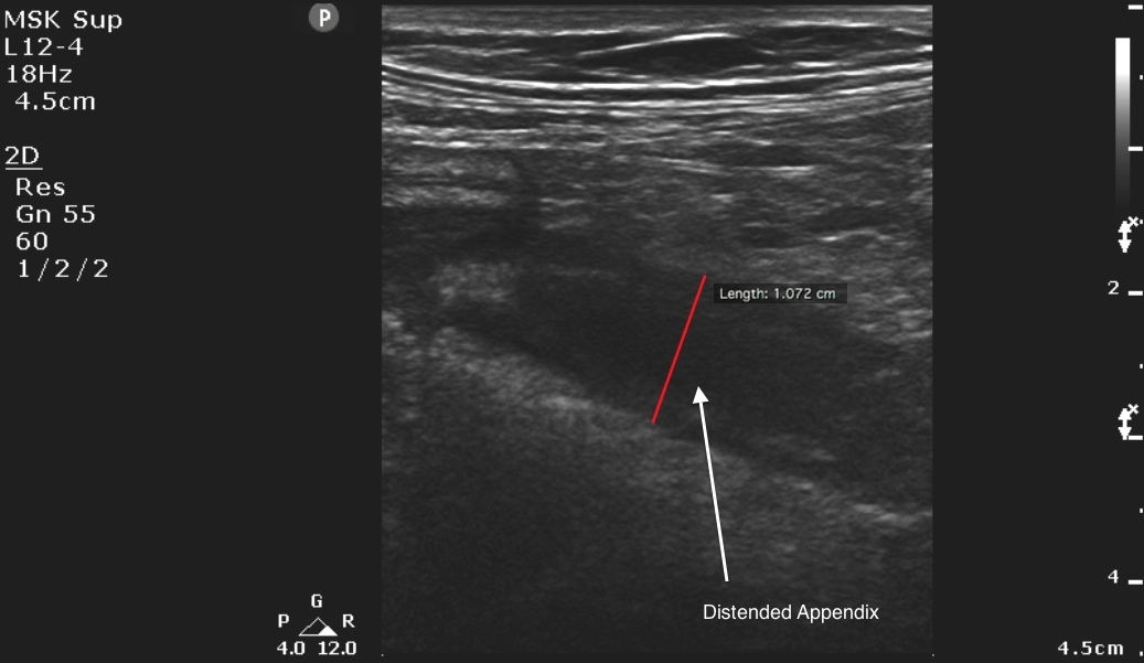 appendicitis