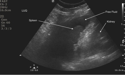 bladder2