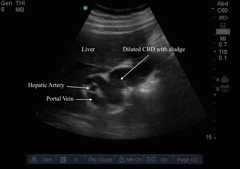 cholangitis1