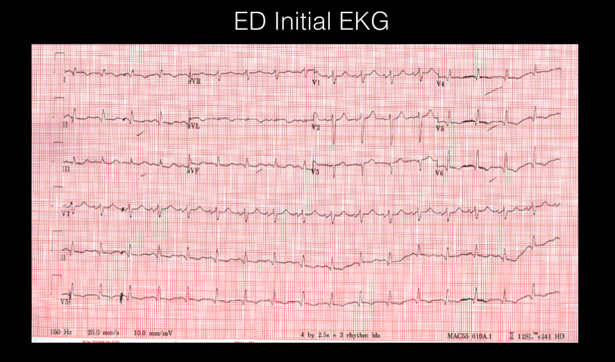 ekg1