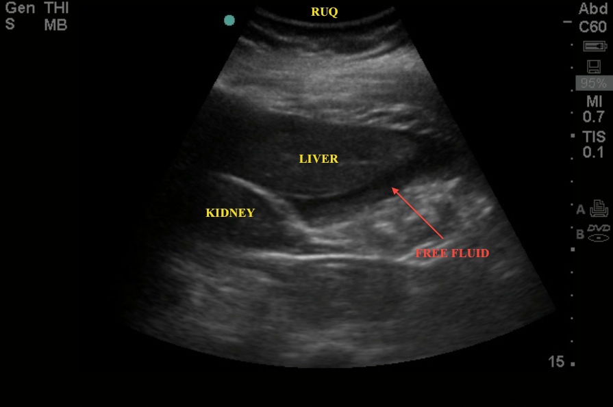 FF RUQ Ectopic