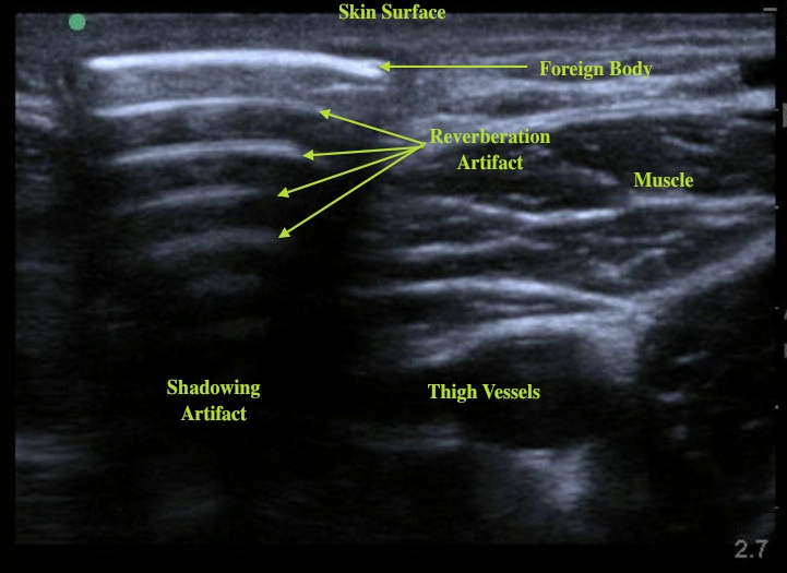 foreignbodylabeled