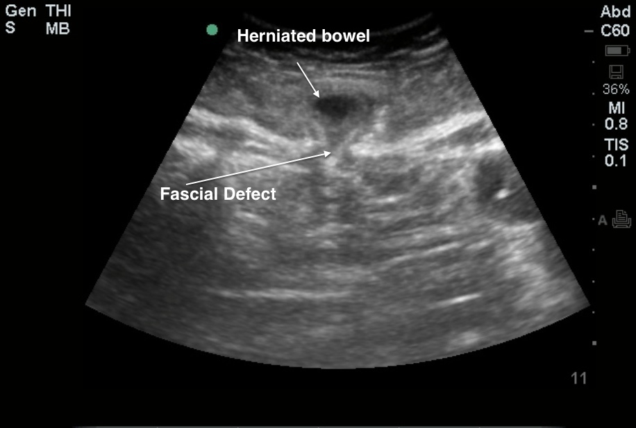 hernia