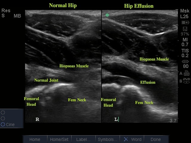 hip effusion