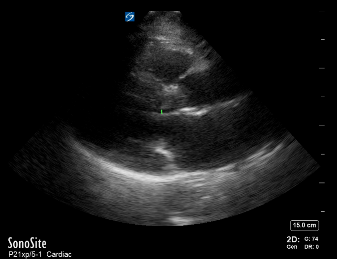 HOCM before BiPAP