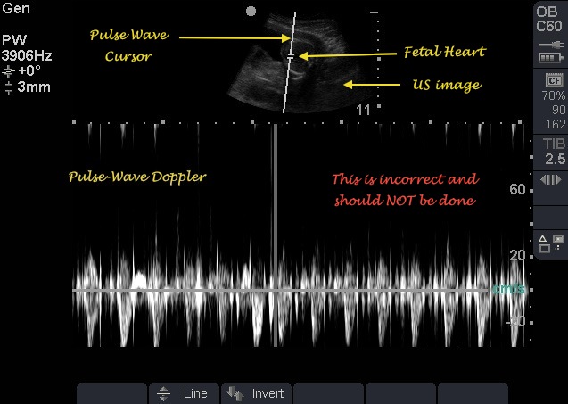 pulse wave doppler