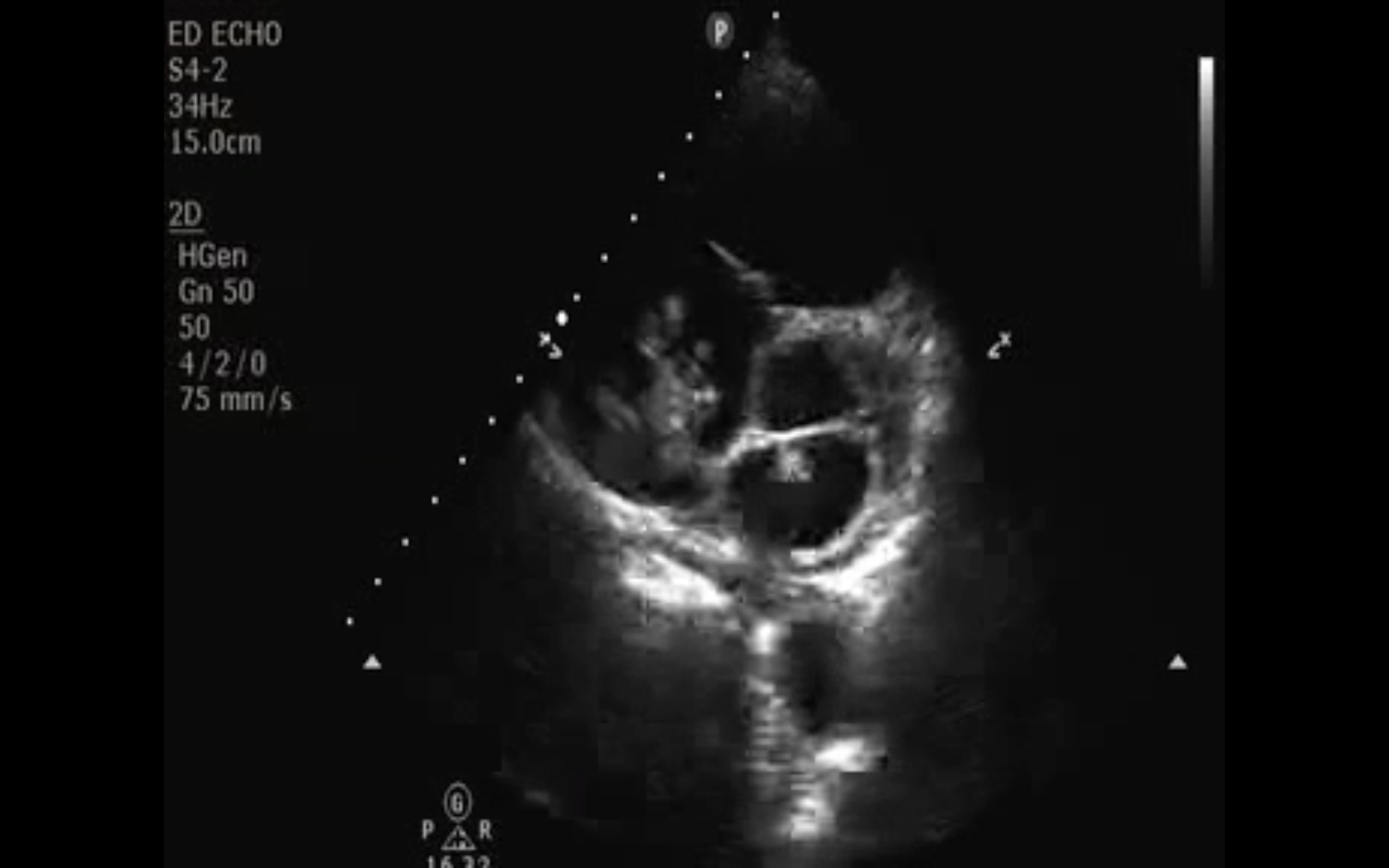 thrombus