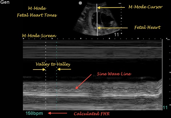 m-mode fetal heart tones