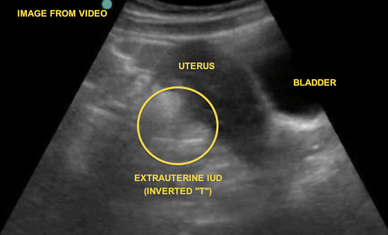 extrauterine