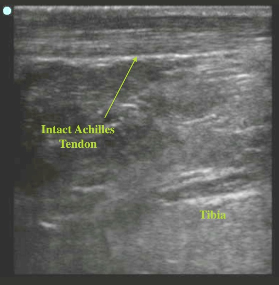 achilles tendon intact