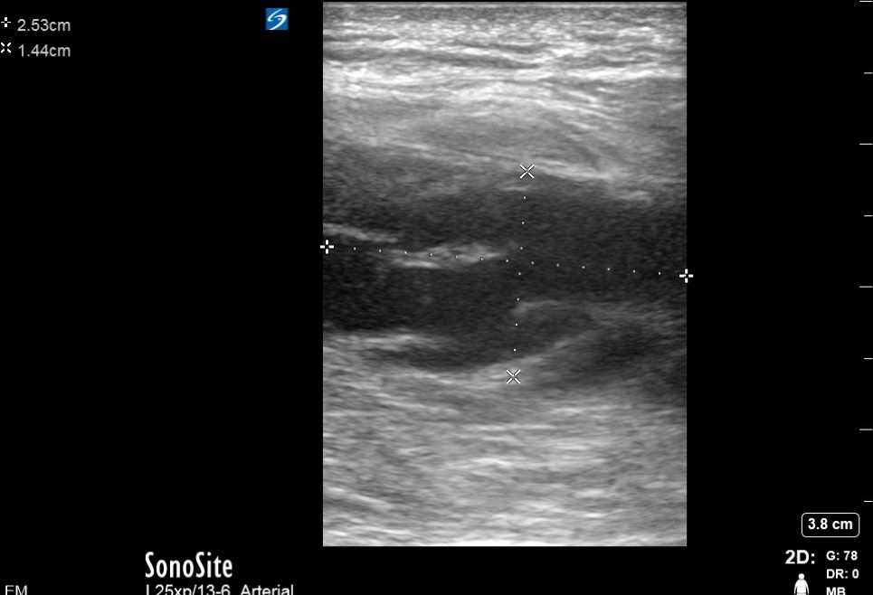 Intramuscular Abscess