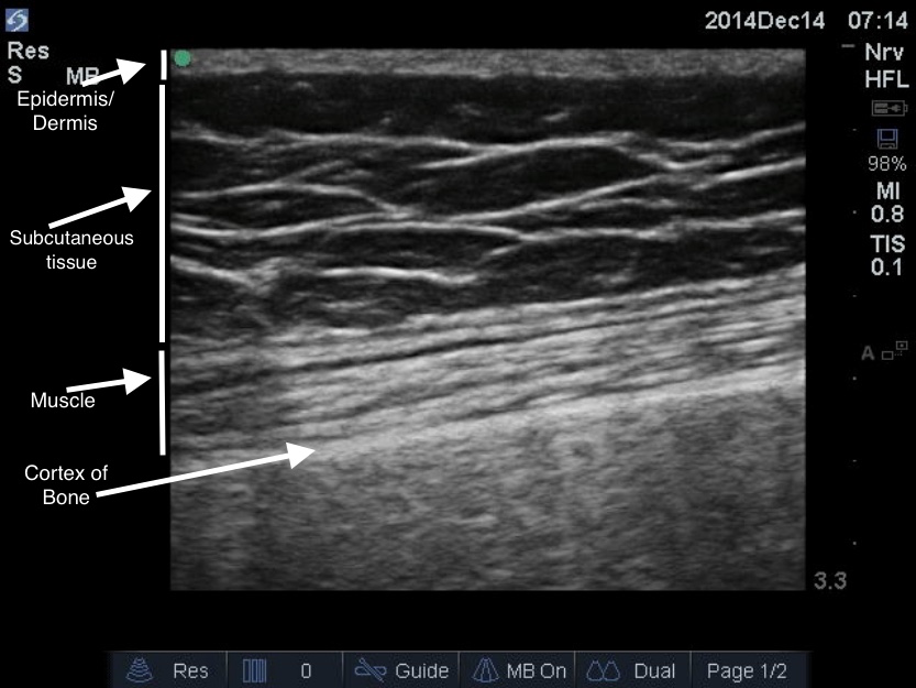 Intramuscular Abscess