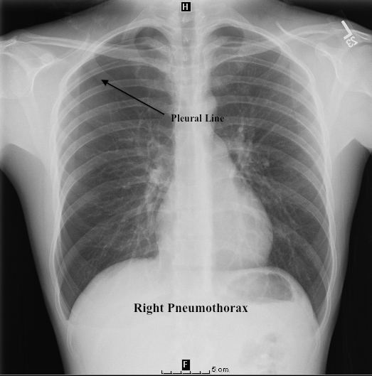 CXR PTHX