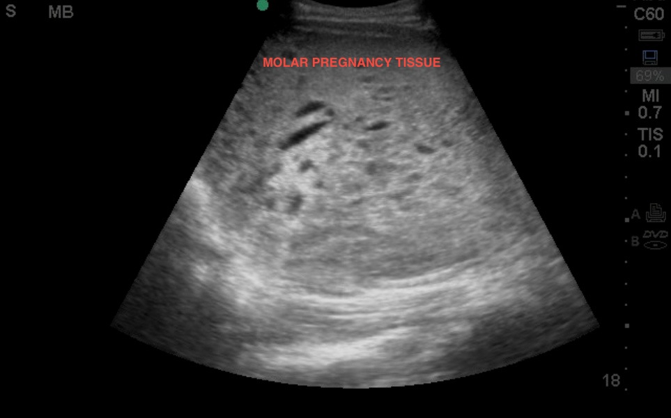 molar pregnancy