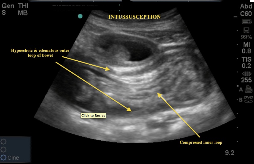 intusseusception