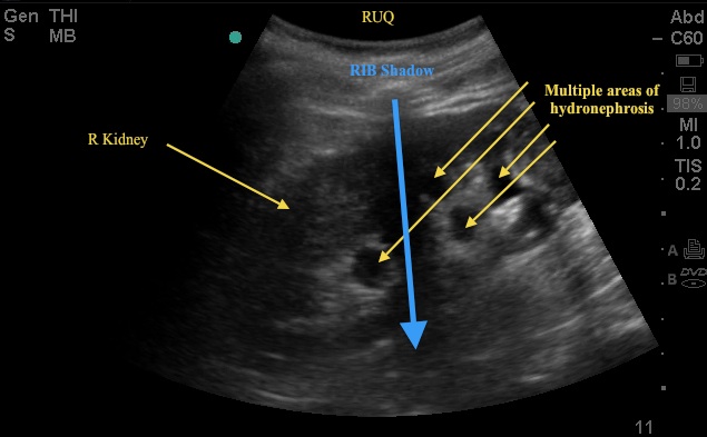 kidney3