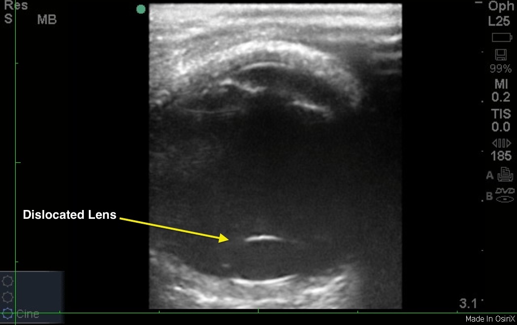 lens dislocation