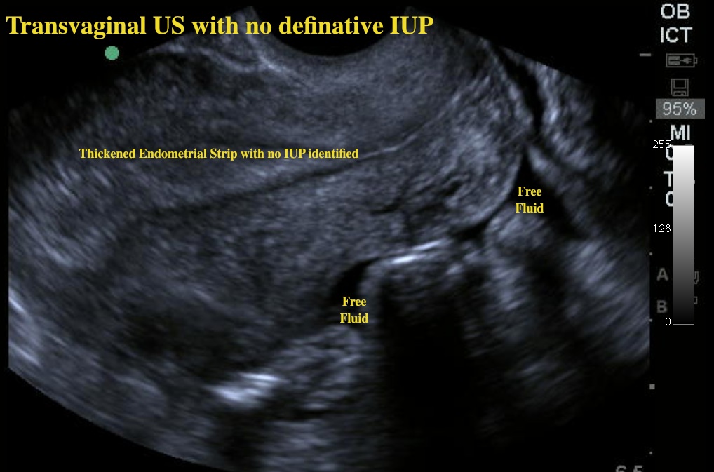 ectopic1