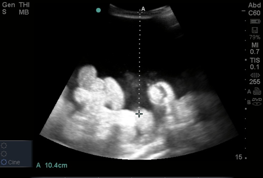 paracentesis