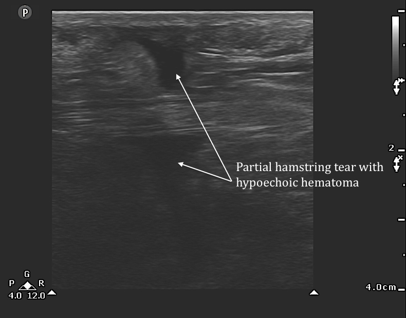 posteriorthigh1