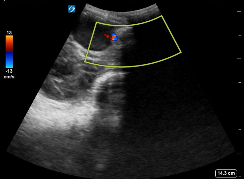 pseudoaneurysm