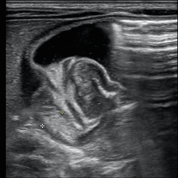 pyloric stenosis