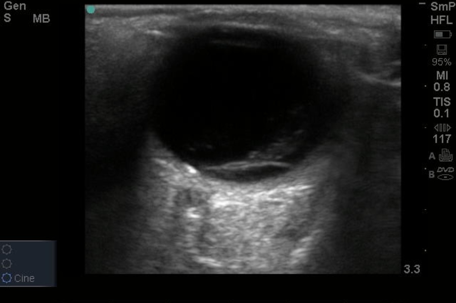 retinal detachment