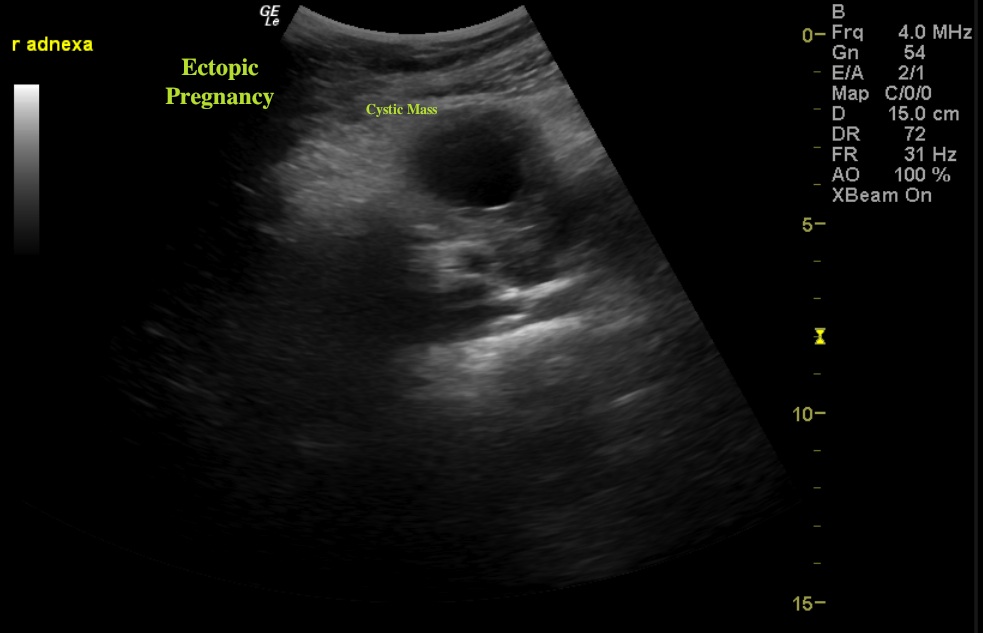 right adenexaectopic