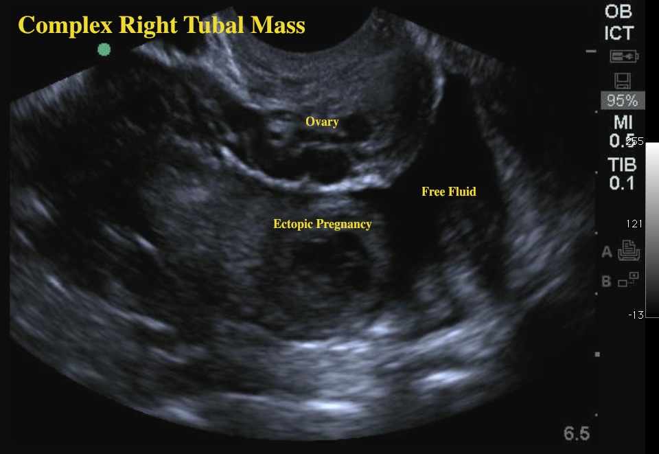 ectopic2