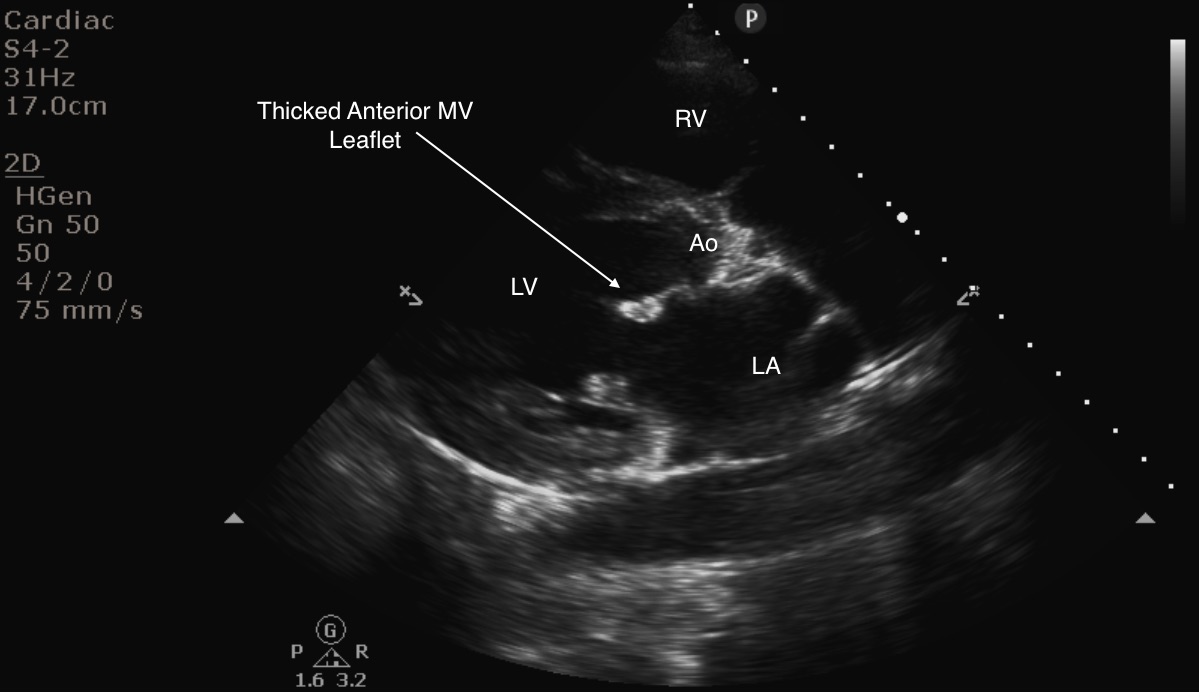 Mitral Valve