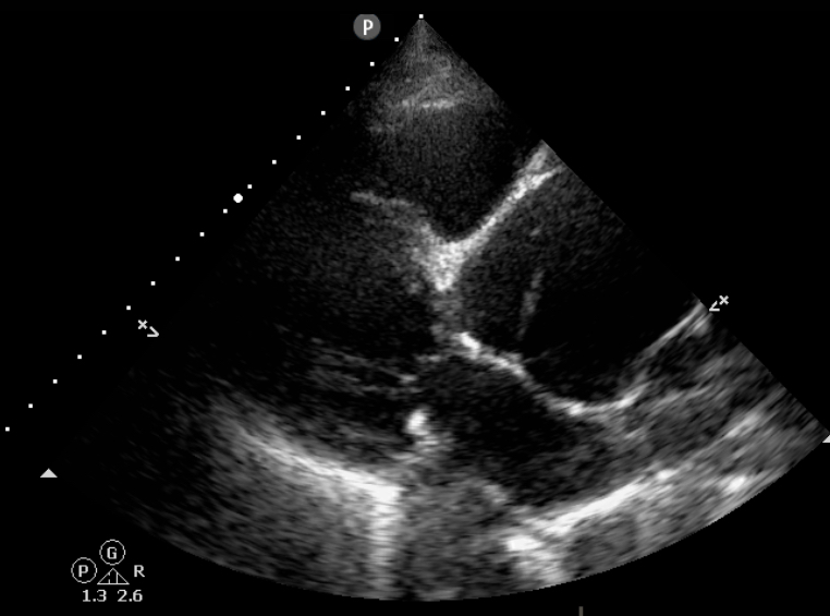 thoracic aorta