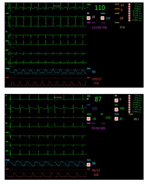 Forecasting Sepsis