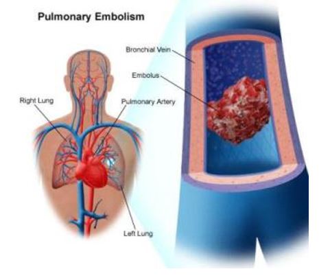 Pulmonary Embolism