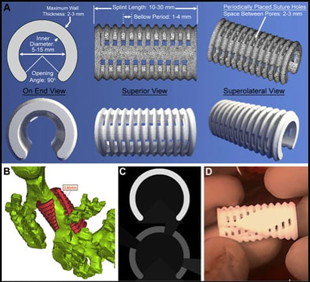 multiple views of the 3d trachael splint 