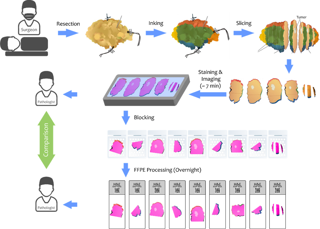 Figure 3. Proposed workflow for the GigaFIBI feasibility and validation study. Breast cancer tumor margins will be evaluated by pathologists and compared using GigaFIBI images to traditional FFPE H&E slides. Surgically resected tissue will be imaged with GigaFIBI before blocking, but after inking, breadloafing, and staining with H&E. After imaging, tissue is returned to routine histology and preserved for downstream testing.