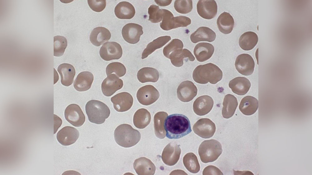 Hematology